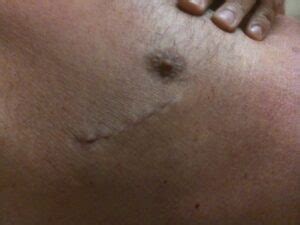 Keyhole surgery scar lump. .  ...