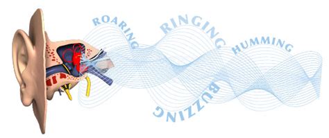 Keyzilen tinnitus. .  ...