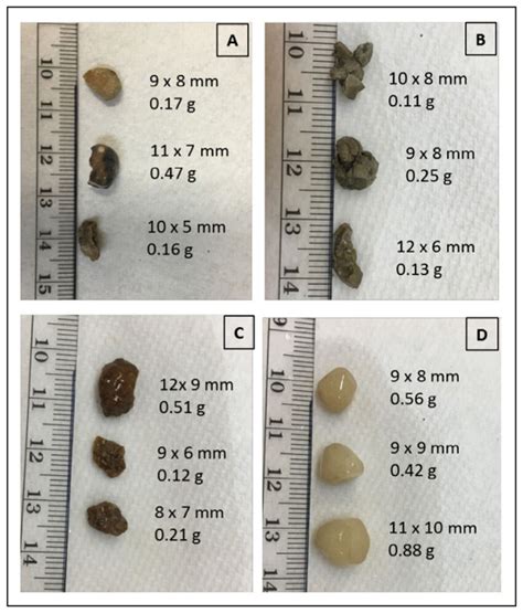 Kidney Stone Size Chart in MM & CM (Millimeter & Centimeter)
