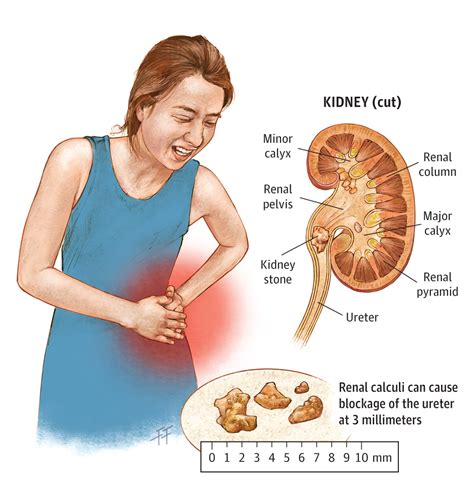 Kidney Stones in Teens: Causes, Symptoms and …