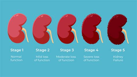 Kidney dysplasia life expectancy