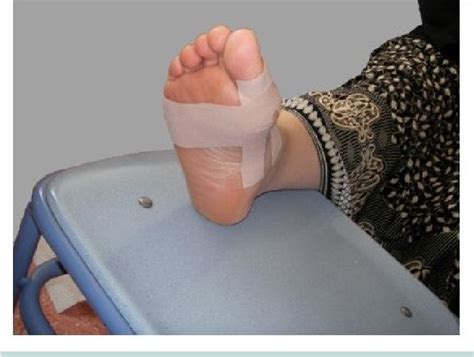 Kinesio-Taping in the Successful Management of Hallux …