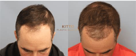 Kitto Plastic Surgery is in Bon Air, VA. January 28, 2021 · "Great experience! Dr. Kitto made Me feel very well taken care of prior to and following my surgery. She made sure I was I informed about the procedure and discussed any concerns I may have. I never felt rushed and could tell she was there for me.. 