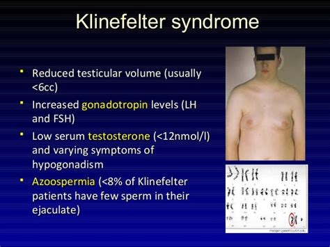 Klinefelter Syndrome Testicular Size Pregnancy Informations
