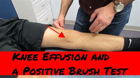 Knee effusion, positive brush test and intra-articular knee …