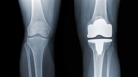 Knee replacement timing is all wrong for most patients - ScienceDaily