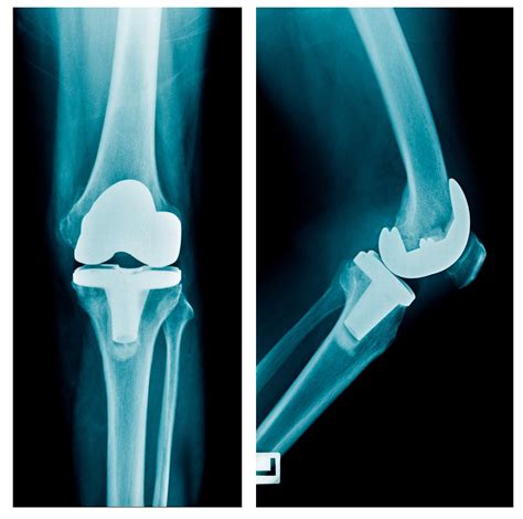 Knee replacement with metal rod above knee - Mayo …