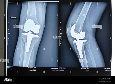 Knee surgery trends and projections in France from 2008 to 2070