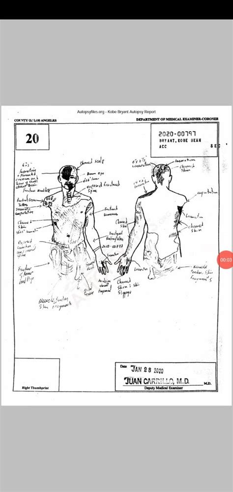 Kobe And Gigi Bryant Autopsy Report And Drawing On Twitter. People online are claiming the autopsy sketch and report were "leaked." However, the Los Angeles County Medical Examiner's office has made the coroner's report and proof of death letter in Kobe Bryant's death available for purchase online. It costs $59 for the autopsy report.. 
