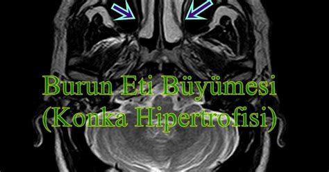 Konka Hipertrofisi (Burun Eti Büyümesi) Liv Hospital.