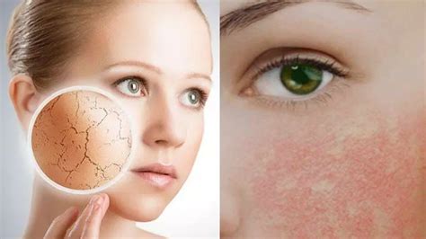 Kuru ciltler maranki.