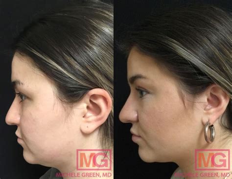 Kybella Neck Lift - Dr. Michele Green M.D.