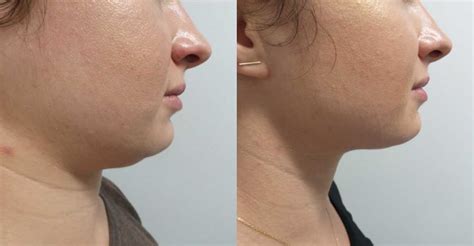 Kybella Review with Before and After Pictures - Shape