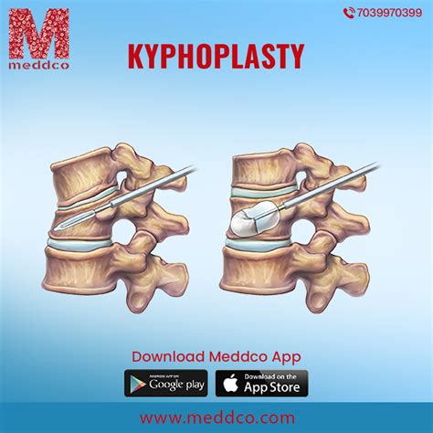 Kyphoplasty Surgery: Meaning, Treatment Procedure, Recovery