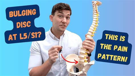L5S1 Bulging Disc Pain Pattern Explained! YouTube