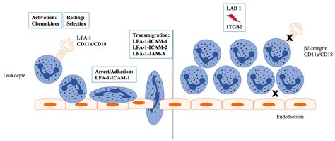 LAD1 - Overview: Leukocyte Adhesion Deficiency Type 1, …