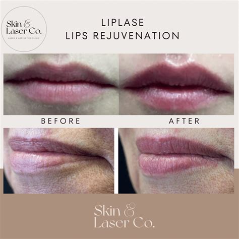 Laser Lip Rejuvenation: Prosedur & Efek Samping | HEYSTETIK - muktibox.com