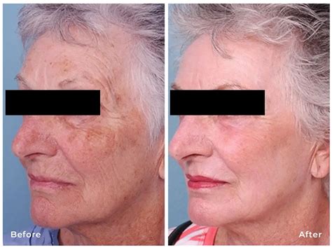 Laser Skin Resurfacing - American Society of Plastic … - wintechmobiles.com