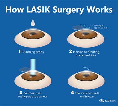 LASIK eye surgery - Mayo Clinic - wintechmobiles.com