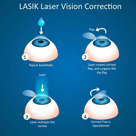 LASIK Procedure Laser Eye Surgery Procedure Diamond Vision