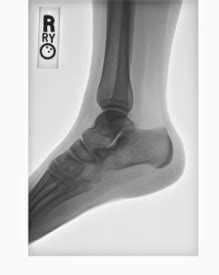 LERA- Lower Extremity RAdiographs Center for Artificial …