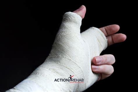 Looking after your plaster cast - uhcw.nhs.uk - muktibox.com