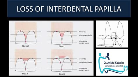 LOSS OF INTERDENTAL PAPILLA NORDLAND & TARNOW …