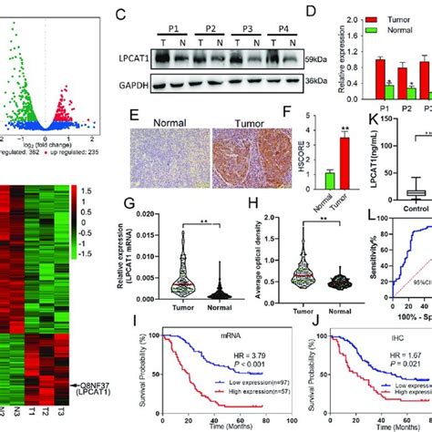 LPCAT1 reprogramming cholesterol metabolism promotes the …