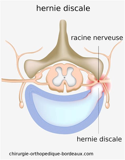 La Sciatique - Hernie Discale