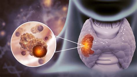 La doctora responde: «Menú sin yodo para el cáncer de tiroides»