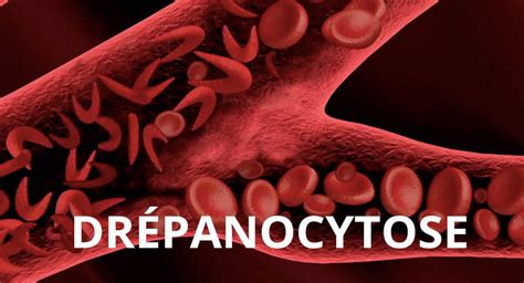 La drépanocytose - Maxicours