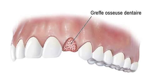 La greffe osseuse dentaire - Ma santé bucco-dentaire