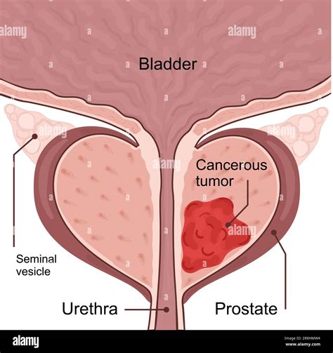 La prostate