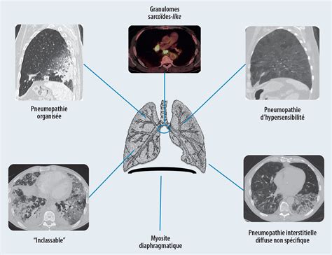 La sénescence cellulaire pulmonaire induite par le virus influenza ...