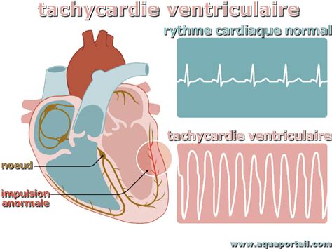 La tachycardie - Doctissimo