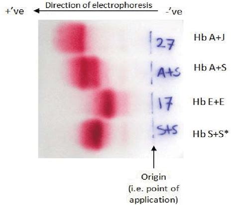 Hemoglobin electrophoresis is a test that measures the different types of hemoglobin in the blood. It also looks for abnormal types of hemoglobin. Hemoglobin (Hgb) F, fetal hemoglobin. This type of hemoglobin is found in unborn babies and newborns. HgbF is replaced by HgbA shortly after birth. . 