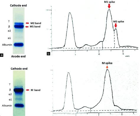 Labcorp protein electrophoresis. Additional Information. Immunofixation electrophoresis of serum or urine is most often ordered to evaluate a monoclonal globulin detected in a protein electrophoresis or to delineate a possible lymphoproliferative process, particularly myeloma. This procedure will help identify the specific light and heavy chain components of a monoclonal protein. 