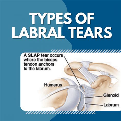 Strictly speaking, a "Bankart lesion" refers to an injury of the labrum and associated glenohumeral capsule/ligaments (see History and etymology below). Injury to these reinforcing soft tissue structures is thought to predispose to recurrent dislocation 7. The term "bony Bankart" (contrasted with a "soft Bankart" or "fibrous Bankart") is often .... 