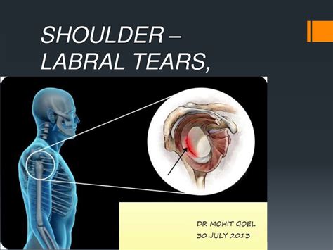 Labrum tear right shoulder icd 10. Code for traumatic labral tear is 840.7, but you are not specify injury type. For non-traumatic labral tear is considered as old tear or old rupture. So we can take 726.2, other specified enthesopathy in shoulder OR 718.01, old rupture of ligament in shoulder region. My suggestion is 718.01 is more specific code for ligament/cartilage rupture ... 