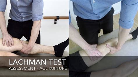 Lachman test. Stability testing included valgus-varus stress testing performed at 0° and 30° of knee flexion, anterior and posterior drawer testing done at 90° of knee flexion with the foot in neutral position, and the stabilized Lachman test performed with a 15.24-cm (6-in) bolster placed under the distal thigh of the model patients to maintain knee flexion at 20° to 30°. 
