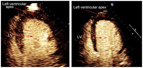 Lack of myocardial perfusion immediately after successful