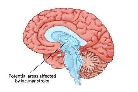 Lacunar Stroke: Symptoms, Treatments, and Long-Term …