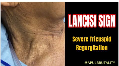 Lancisi sign: prominent C–V waves of severe tricuspid regurgitation