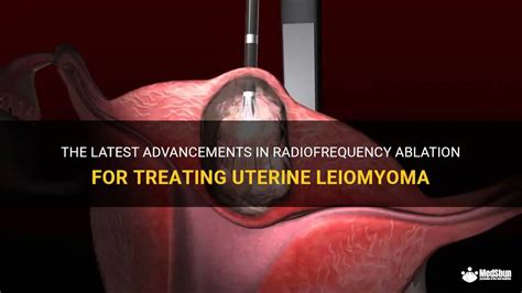 Laparoscopic Radiofrequency Ablation of Uterine Leiomyomas…