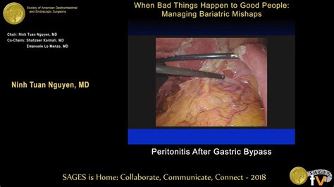 Laparoscopic Repair of Perforated Duodenal Ulcers