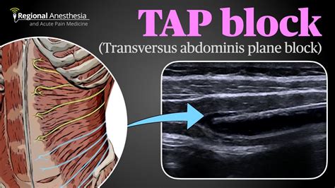 Laparoscopic Transversus Abdominis Plane Block in