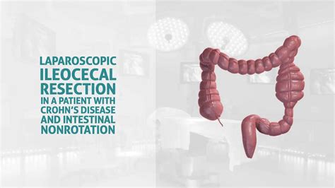 Laparoscopic-assisted ileocolic resections in patients with Crohn