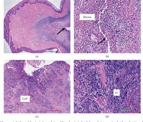 Large Draining Focal Fibrous Hyperplasia Secondary to