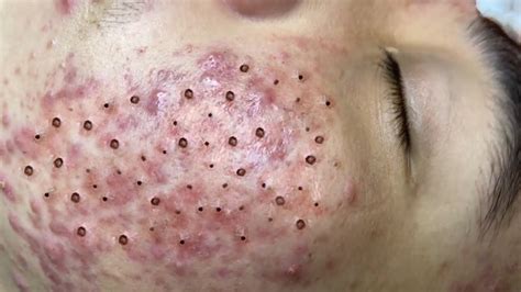 Large blackhead on face. Blackheads on Nose and Forehead. Pimple popping videosMUSIC:Kevin MacLeod (incompetech.com)Licensed under Creative Commons: By Attribution 3.0 Licensehttp://... 