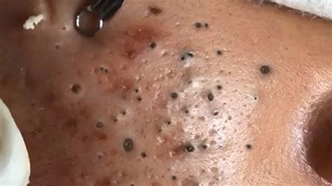Large blackhead pop. What’s Poppin Everybody?!?! I’m BACK with a NEW video!For those of you that don’t know, I’m a popaholic just like all of you that have clicked on this video... 